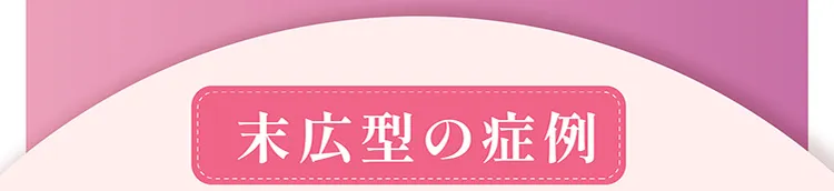 ナチュラルデザイン二重埋没症例