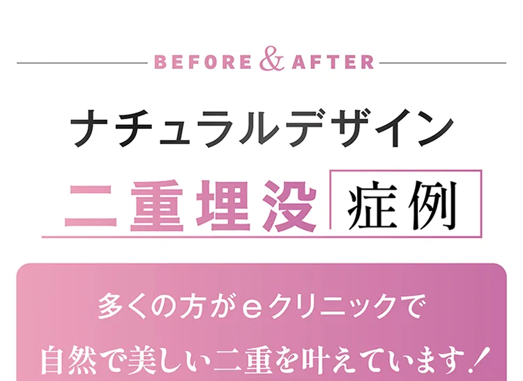 ナチュラルデザイン二重埋没症例