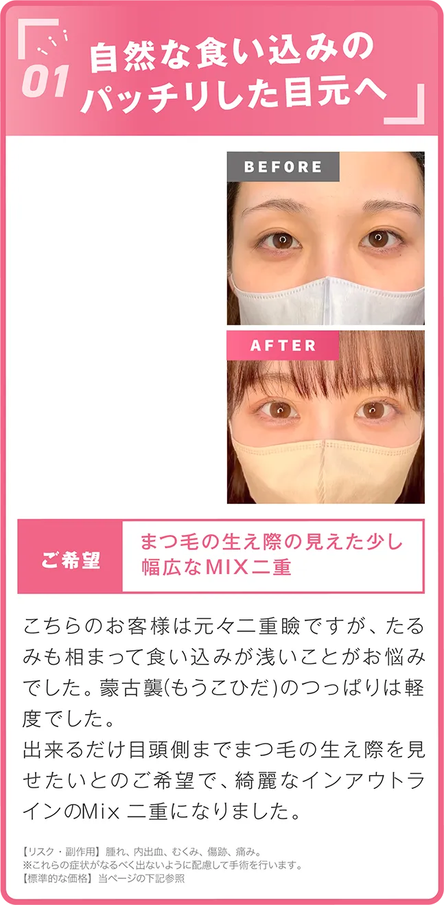 自然な食い込みのぱっちりした二重に