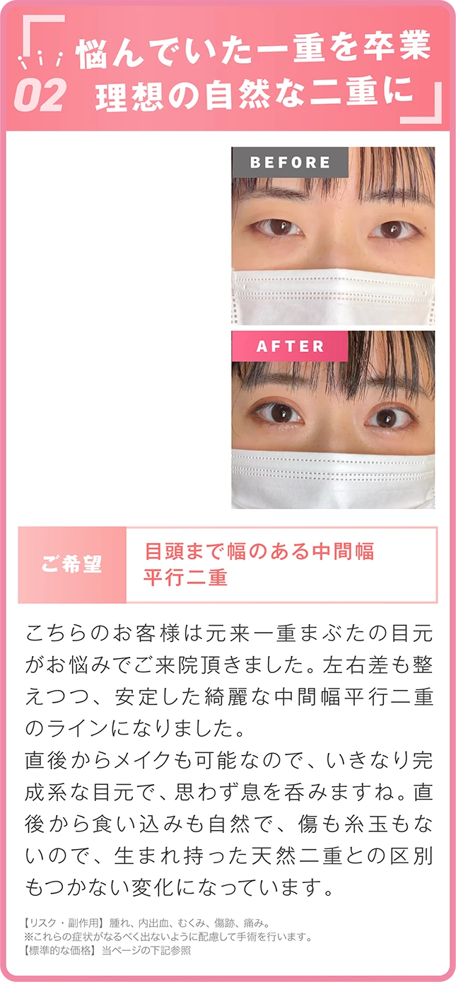 整形感のない自然な二重へ