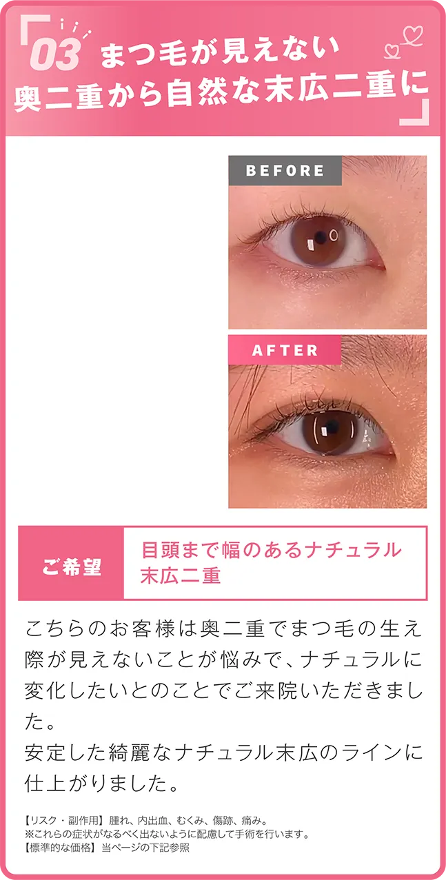 自然な末広二重へ